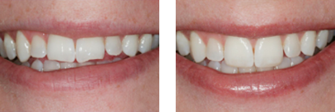 Dental Veneers before and after photos