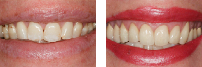 Dental Veneers before and after photos