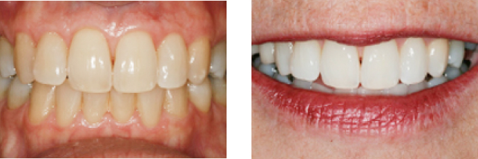 Dental Veneers before and after photos