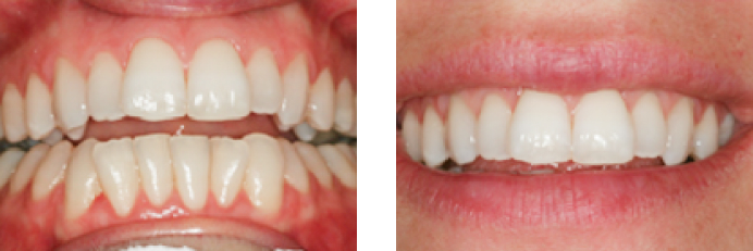 Dental Veneers before and after photos