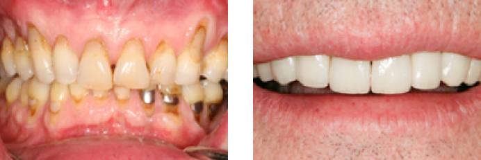 Dental Veneers before and after photos