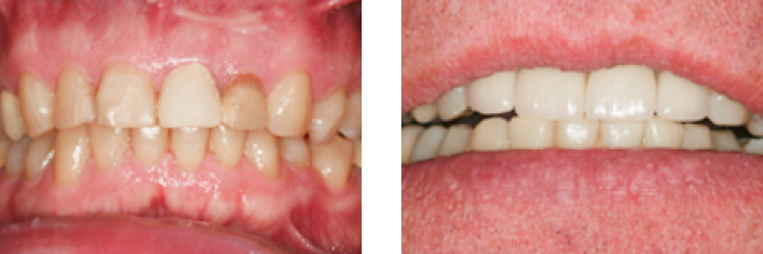 Dental Veneers before and after photos